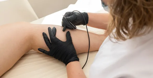 Épilation électrique