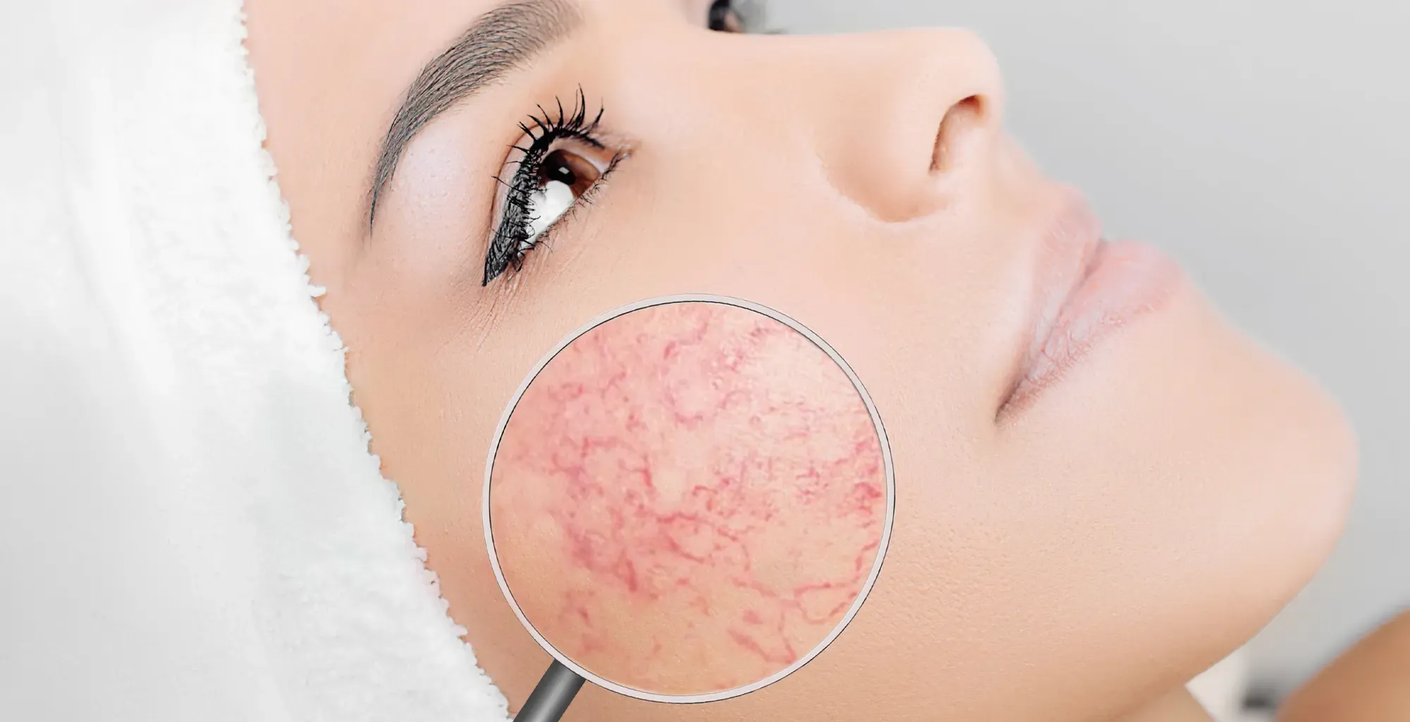 Laser vasculaire Derma V aux Sables d'Olonne