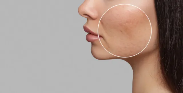 Les cicatrices d’acné