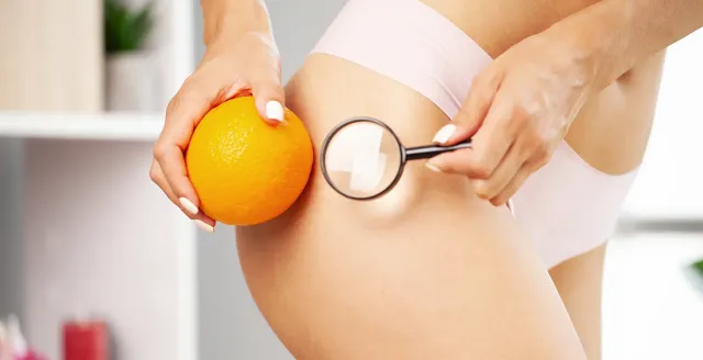 La cellulite