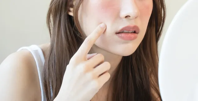 Les rougeurs du visage